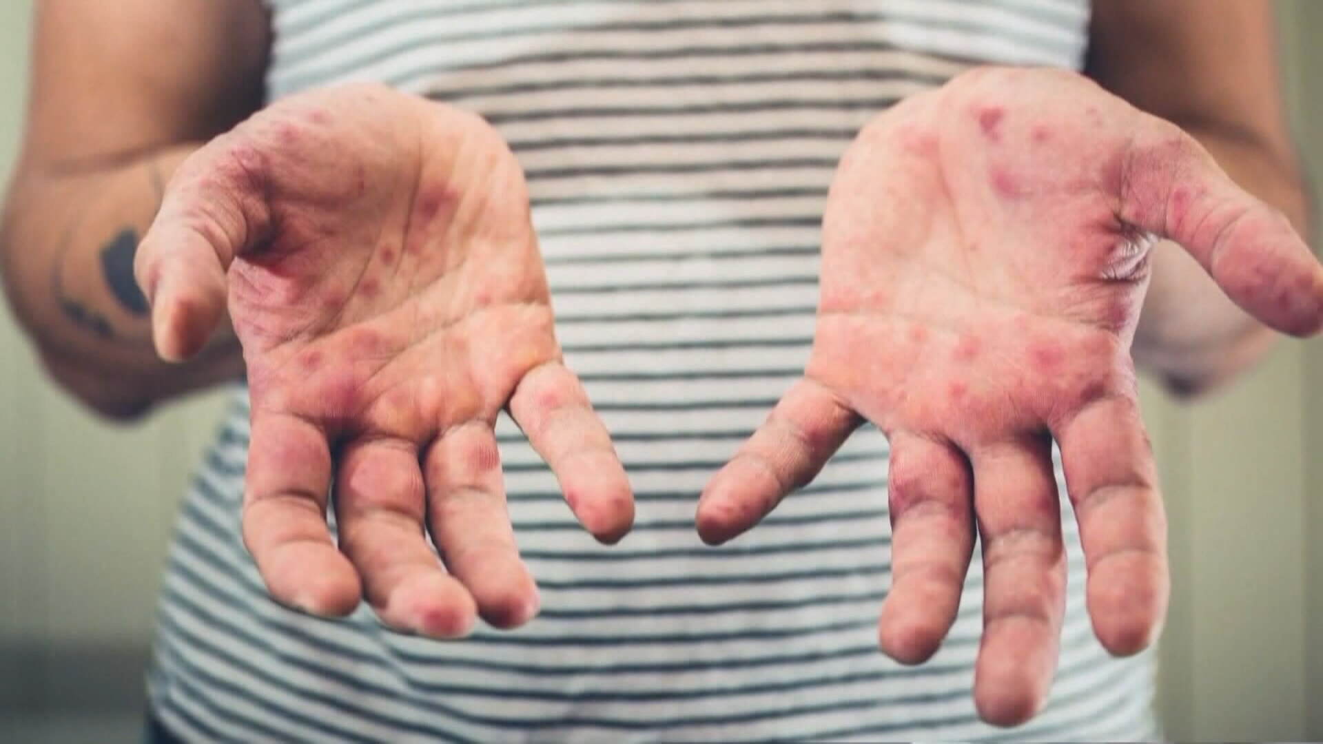 Calgarians being warned about possible exposure to a confirmed case of measles