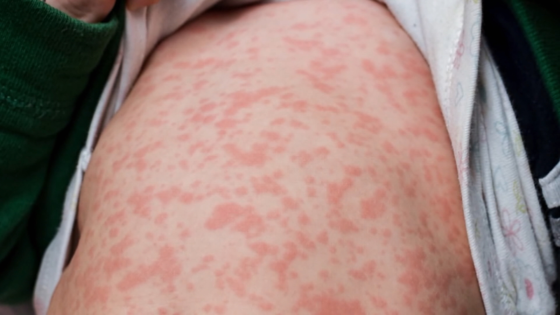 Winnipeg locations among latest measles exposure sites in Manitoba